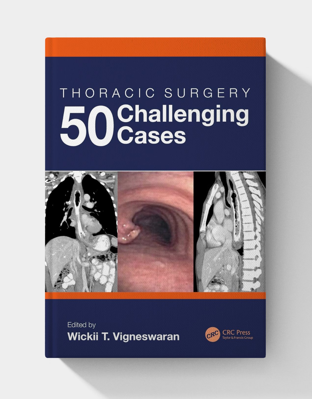 Thoracic Surgery: 50 Challenging cases (1st Edition) Thoracic Surgery: 50 Challenging cases (1st Edition)